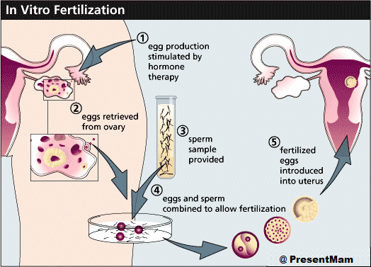 IVF in Pakistan